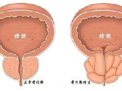 【科普】前列腺增生健康科普小知识