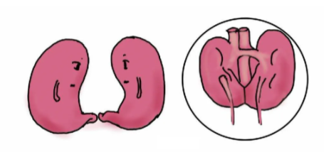 【医讯】腰痛难忍竟是“马蹄肾并结石”
