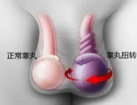【科普】从蛋疼到丢蛋的路其实并不远，请小心“睾丸扭转”