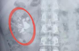 腰痛难忍,竟是被忽略的“小结石”惹的祸