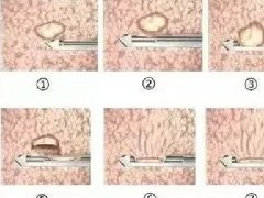 【担当卫健】乳腺微创旋切手术
