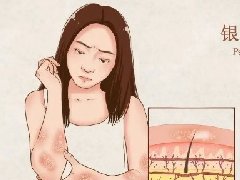 【世界银屑病日】什么是银屑病？傻傻分不清的“屑”与“癣”