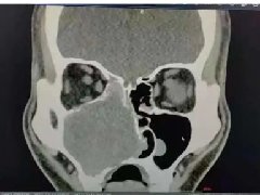 【作风卫健】诊疗技术取得新突破！红河州第二人民医院成功开展首例鼻腔恶性