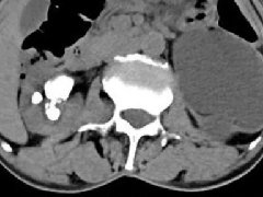 【担当卫健】“肾脏折叠技术”成功为一例复杂难治的泌尿系结石患者保住肾脏