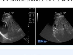 【健康科普】“消失的囊肿”——超声引导下肝肾囊肿微创治疗