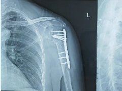 【担当卫健】红河州第二人民医院成功开展首例反式肩关节置换术