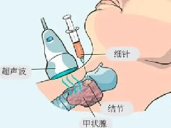 【健康科普】超声引导下甲状腺结节的细针穿刺活检