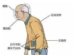 【心理健康科普月月讲】抗精神病药物副作用之锥体外系反应