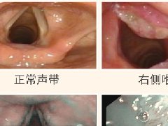 红河州第二人民医院成功完成首例喉鳞状细胞癌根治性手术