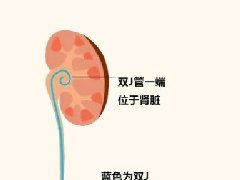 【健康科普】别让输尿管支架“超期服役”——这根管子，不能遗忘！