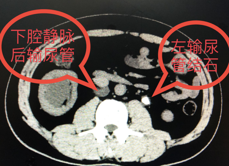 【医讯】折磨他多年的结石,被我院泌尿外科团队顺利取出