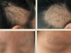 【心理健康科普月月讲】反复拔毛也是病？