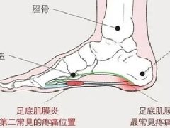 【健康科普】踩在刀尖上的痛——足底筋膜炎