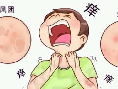 【健康科普】急性荨麻疹:那些突然“冒出来”的痒痒风团,您了解多少?